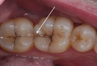 Crack Teeth: Great Treatments, Causes and Preventions Crack Teeth: Great Treatments, Causes and Preventions