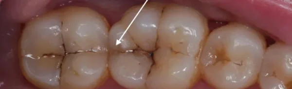 Crack Teeth: Great Treatments, Causes and Preventions