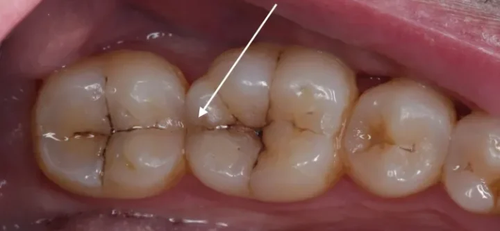 Crack Teeth: Great Treatments, Causes and Preventions