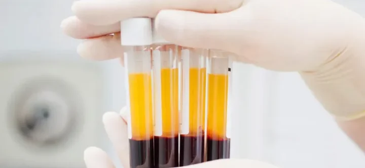 PRF in Dentistry: Great Guide for Dental Professionals